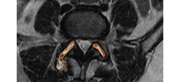 Liliana Rozo - Articulo -DolorLumbarOrigenArticular