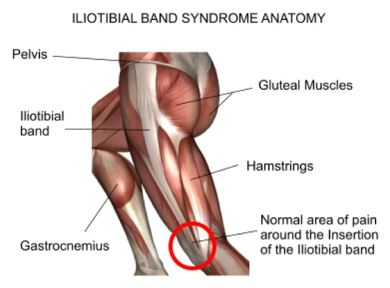 SÍndrome de Fricción de la Banda Iliotibial - Liliana Rozo