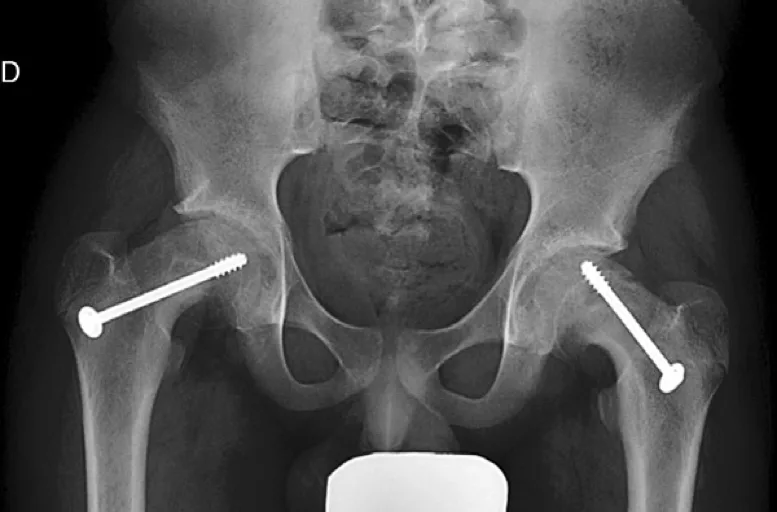 Epifisiolisis-Cabeza-Femoral8