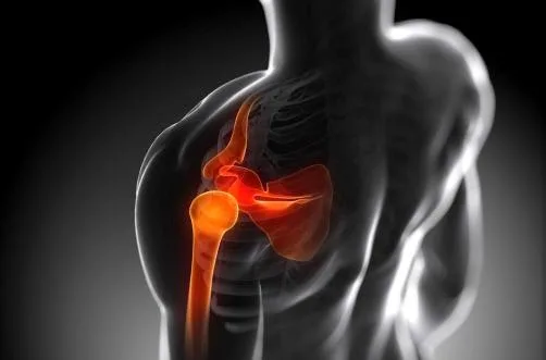 Pinzamiento Subacromial y Disfunción Muscular Escapular