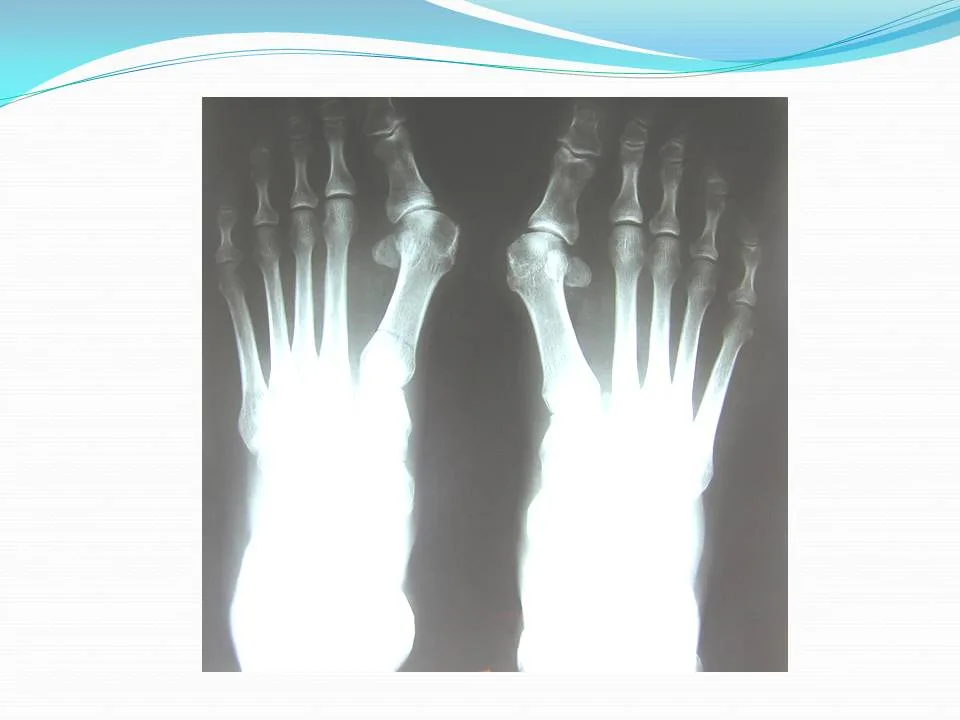 Kinesiologia en hallux valgus operado recuperacion funcional