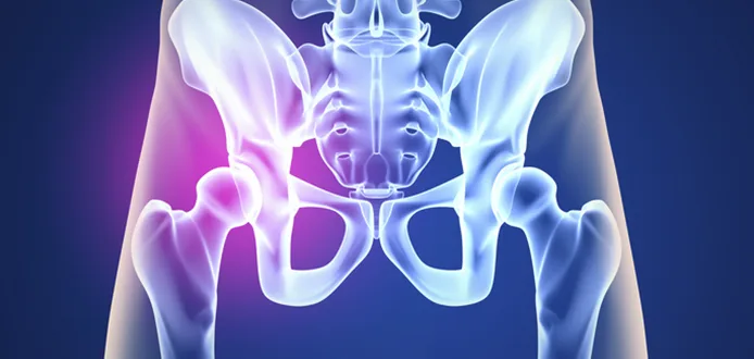 Epifisiolisis de la Cabeza Femoral