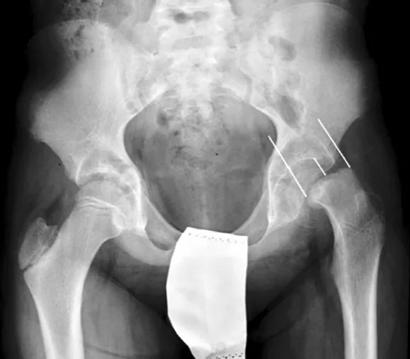 Epifisiolisis-Cabeza-Femoral3