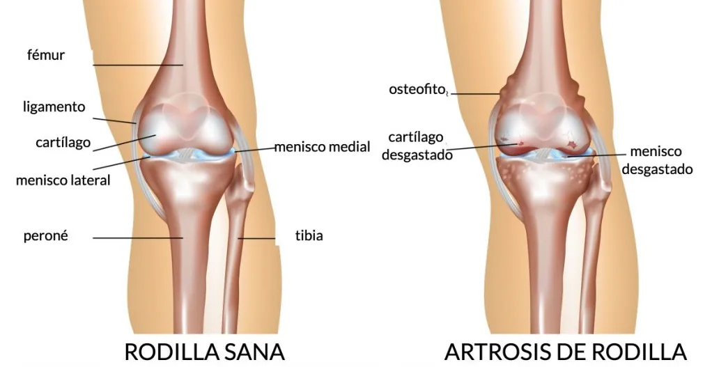 Tesis Artrosis Rodilla