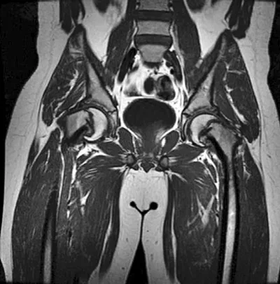 Epifisiolisis-Cabeza-Femoral7